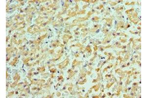 Immunohistochemistry of paraffin-embedded human liver cancer using ABIN7143181 at dilution of 1:100 (ACVR2A anticorps  (AA 20-140))