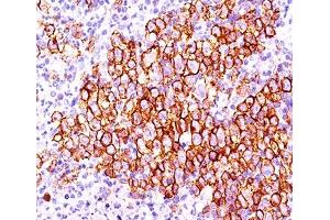 IHC testing of Hodgkin's lymphoma (20X) stained with CD30 antibody (CD30/412). (TNFRSF8 anticorps)