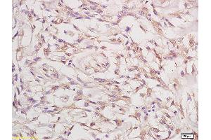 Formalin-fixed and paraffin embedded human cervical carcinoma labeled with Anti-Phospho-FGFR1+FGFR2 (Tyr463) Polyclonal Antibody, Unconjugated (ABIN758197) at 1:200 followed by conjugation to the secondary antibody and DAB staining (FGFR1/FGFR2 anticorps  (pTyr463, pTyr466))