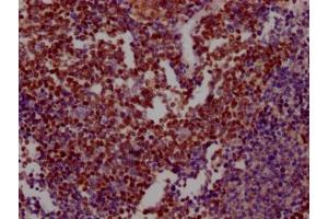 IHC image of ABIN7127596 diluted at 1:100 and staining in paraffin-embedded human lung cancer performed on a Leica BondTM system.