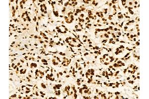 Phospho-Hexokinase 1 (Tyr732) Antibody at 1/100 staining Human pancreatic cancer and adjacent nomal tissues by IHC-P. (Hexokinase 1 anticorps  (pTyr732))