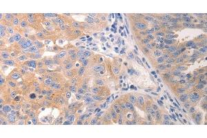 Immunohistochemistry of paraffin-embedded Human breast cancer tissue using CK-6A/B/C Polyclonal Antibody at dilution 1:50 (CK-6A/B/C anticorps)