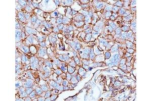 IHC testing of human breast cancer stained with HCAM antibody (156-3C11).