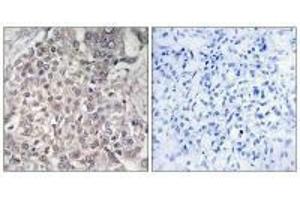 Immunohistochemistry analysis of paraffin-embedded human liver carcinoma tissue using Cytochrome P450 4F2 antibody.