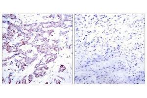 Immunohistochemical analysis of paraffin-embedded human breast carcinoma tissue using STAT6(Phospho-Thr645) Antibody(left) or the same antibody preincubated with blocking peptide(right).