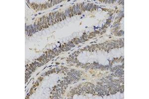 Immunohistochemistry of paraffin-embedded human rectal cancer using Trimethyl-Histone H3-K4 antibody (ABIN5969804) at dilution of 1/200 (40x lens). (Histone 3 anticorps  (H3K4me3))