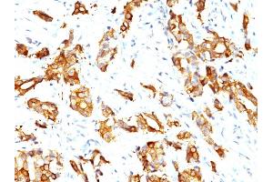 Formalin-fixed, paraffin-embedded human Breast Carcinoma stained with HSP27 Monoclonal Antibody (HSPB1/774)