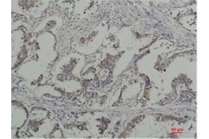 Immunohistochemical analysis of paraffin-embedded Human Breast Caricnoma using PhosphotyrosineMouse mAb diluted at 1:200. (Phosphotyrosine anticorps)