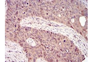 Immunohistochemical analysis of paraffin-embedded cervical cancer tissues using CCNA2 mouse mAb with DAB staining. (Cyclin A anticorps  (AA 105-233))