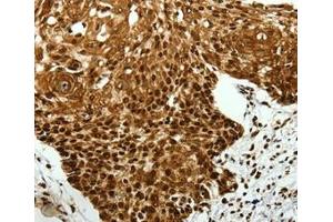Immunohistochemical analysis of paraffin-embedded Human cervical cancer tissue using at dilution 1/40. (SCN11A anticorps  (Internal Region))