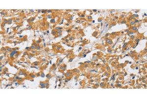 Immunohistochemistry of paraffin-embedded Human thyroid cancer using ARHGAP15 Polyclonal Antibody at dilution of 1:50 (ARHGAP15 anticorps)