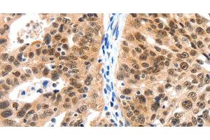 Immunohistochemistry of paraffin-embedded Human ovarian cancer tissue using LRP5 Polyclonal Antibody at dilution 1:115