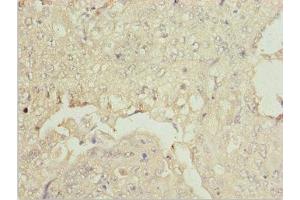 Immunohistochemistry of paraffin-embedded human lung cancer using ABIN7176007 at dilution of 1:100 (ZNF187 anticorps  (AA 239-478))