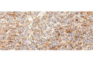 Immunohistochemistry of paraffin-embedded Human liver cancer using ZNF365 Polyclonal Antibody at dilution of 1/20