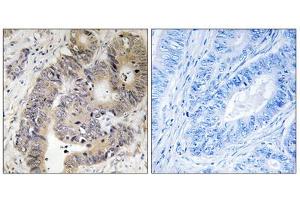 Immunohistochemistry analysis of paraffin-embedded human colon carcinoma tissue using CAD (Phospho-Thr456) antibody. (CAD anticorps  (pThr456))