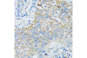 Immunohistochemistry of paraffin-embedded human lung cancer using CTNNA1 antibody (ABIN1876836) at dilution of 1:100 (40x lens). (CTNNA1 anticorps)