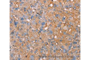 Immunohistochemistry of Human liver cancer using PAGE5 Polyclonal Antibody at dilution of 1:55 (PAGE5 anticorps)