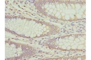 Immunohistochemistry of paraffin-embedded human colon cancer using ABIN7144377 at dilution of 1:100