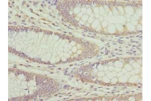 Immunohistochemistry of paraffin-embedded human colon cancer using ABIN7144377 at dilution of 1:100 (AP3B1 anticorps  (AA 895-1094))