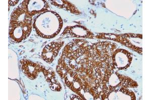 Formalin-fixed, paraffin-embedded human Breast Cancer stained with Beta-Catenin Mouse Recombinant Monoclonal Ab (rCTNNB1/2173).