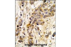 Formalin-fixed and paraffin-embedded human breast carcinoma tissue reacted with IARS2 antibody (Center) , which was peroxidase-conjugated to the secondary antibody, followed by DAB staining. (IARS2 anticorps  (AA 600-628))