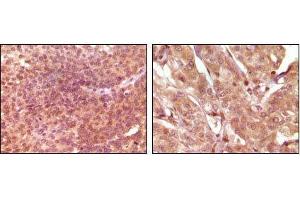 Immunohistochemical analysis of paraffin-embedded human bladder carcinoma (left) and breast carcinoma (right), showing nuclear and cytoplasmic localization using SRA mouse mAb with DAB staining. (SRA1 anticorps)