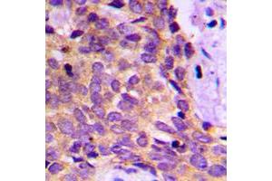 Immunohistochemical analysis of PRKAR1B staining in human breast cancer formalin fixed paraffin embedded tissue section. (PRKAR1B anticorps  (Center))