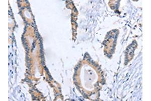 The image on the left is immunohistochemistry of paraffin-embedded Human colon cancer tissue using ABIN7189998(BOD1 Antibody) at dilution 1/30, on the right is treated with synthetic peptide. (BOD1 anticorps)