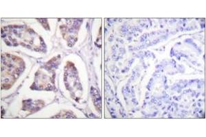 Immunohistochemistry analysis of paraffin-embedded human breast carcinoma tissue, using Vinculin (Ab-821) Antibody.