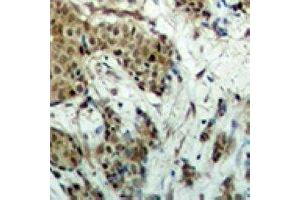 Immunohistochemical analysis of EVI1 staining in human breast cancer formalin fixed paraffin embedded tissue section. (MECOM anticorps)