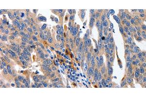 Immunohistochemistry of paraffin-embedded Human ovarian cancer using IL18 Polyclonal Antibody at dilution of 1:100 (IL-18 anticorps)