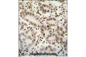 HIST1H2B antibody (Center) (ABIN654684 and ABIN2844377) immunohistochemistry analysis in formalin fixed and paraffin embedded human hepatocarcinoma followed by peroxidase conjugation of the secondary antibody and DAB staining. (HIST1H2BJ anticorps  (AA 57-86))