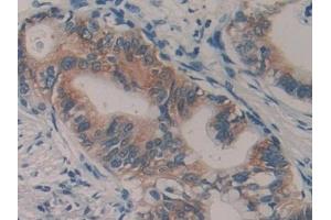 Detection of TMPRSS4 in Human Pancreatic cancer Tissue using Polyclonal Antibody to Transmembrane Protease, Serine 4 (TMPRSS4)