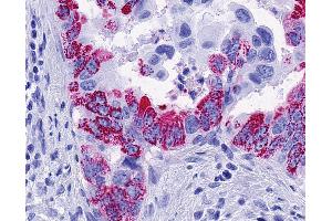 Anti-FFAR2 / GPR43 antibody IHC of human Pancreas, Carcinoma. (FFAR2 anticorps  (Cytoplasmic Domain))