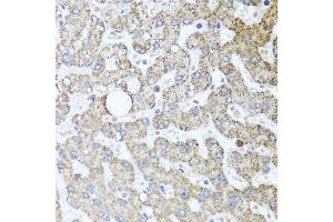Immunohistochemistry of paraffin-embedded human liver injury using TSG101 antibody (ABIN5999112) at dilution of 1/100 (40x lens). (TSG101 anticorps)