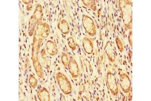 Immunohistochemistry of paraffin-embedded human gastric cancer using ABIN7152927 at dilution of 1:100 (FBLN7 anticorps  (AA 25-393))