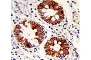 IHC analysis of FFPE human colon carcinoma with Cytokeratin-18 antibody