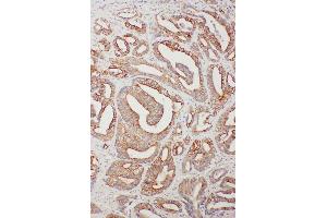 Anti-TNFAIP8L3 antibody, IHC(P) IHC(P): Human Intestinal Cancer Tissue (TNFAIP8L3 anticorps  (C-Term))