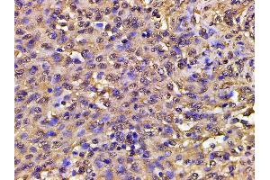 ABIN6267452 at 1/200 staining human meningeal carcinomatosis(MC) tissue sections by IHC-P.