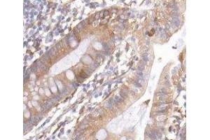 ABIN6277128 at 1/200 staining Human colon cancer tissue sections by IHC-P.