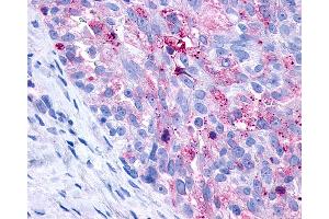Anti-P2Y10 / P2RY10 antibody IHC of human Ovary, Carcinoma.