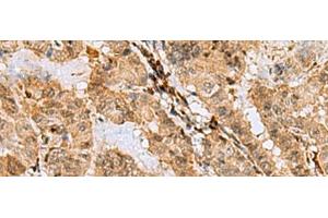 Immunohistochemistry of paraffin-embedded Human thyroid cancer tissue using ASNA1 Polyclonal Antibody at dilution of 1:70(x200) (ASNA1 anticorps)