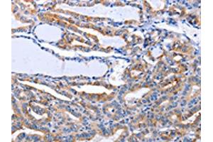 The image on the left is immunohistochemistry of paraffin-embedded Human thyroid cancer tissue using ABIN7191274(LIF Antibody) at dilution 1/25, on the right is treated with synthetic peptide. (LIF anticorps)