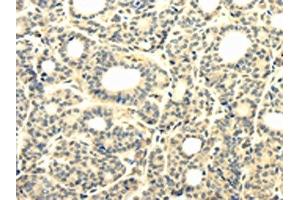 The image on the left is immunohistochemistry of paraffin-embedded Human thyroid cancer tissue using ABIN7131302(TBC1D22A Antibody) at dilution 1/25, on the right is treated with fusion protein. (TBC1D22A anticorps)