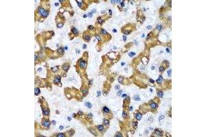 Immunohistochemical analysis of VAP-B/C staining in human liver cancer formalin fixed paraffin embedded tissue section.