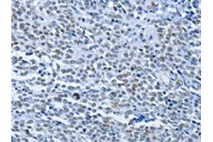 The image on the left is immunohistochemistry of paraffin-embedded Human ovarian cancer tissue using ABIN7190072(CBX1 Antibody) at dilution 1/30, on the right is treated with synthetic peptide.