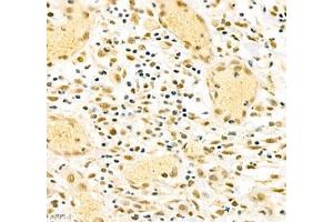 Immunohistochemistry of paraffin embedded human gastric cancer using PABPN1 (ABIN7075116) at dilution of 1:600 (400x lens) (PABPN1 anticorps)