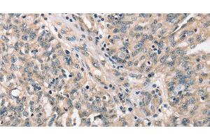 Immunohistochemistry of paraffin-embedded Human ovarian cancer tissue using CDK12 Polyclonal Antibody at dilution 1:30 (CDK12 anticorps)