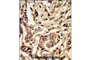 Formalin-fixed and paraffin-embedded human breast carcinoma reacted with GALT Antibody , which was peroxidase-conjugated to the secondary antibody, followed by DAB staining. (GALT anticorps  (C-Term))