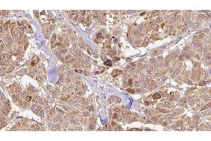 ABIN6276495 at 1/100 staining Human Melanoma tissue by IHC-P. (Neurotrophin 4 anticorps  (Internal Region))